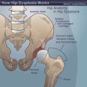 Dysplastic Hip