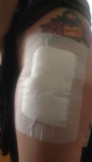 Screw removal -- Right hip (gauzed) (2)