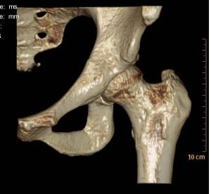 My left pelvis and femur